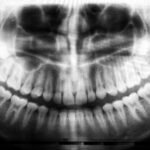 teeth X-ray